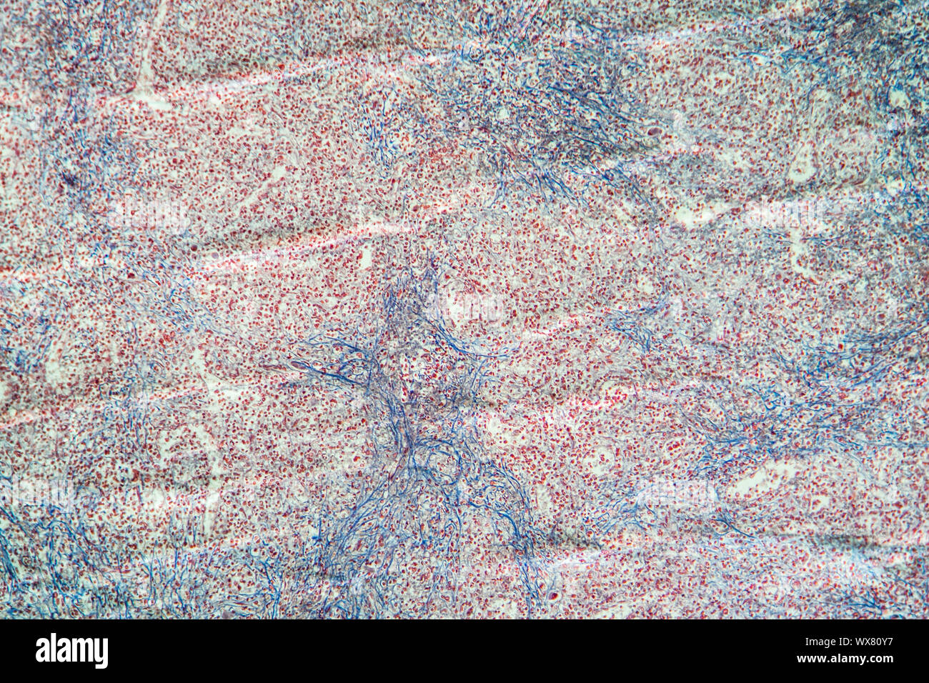 Cronica leucemia mieloide di milza di un tessuto malato 100x Foto Stock