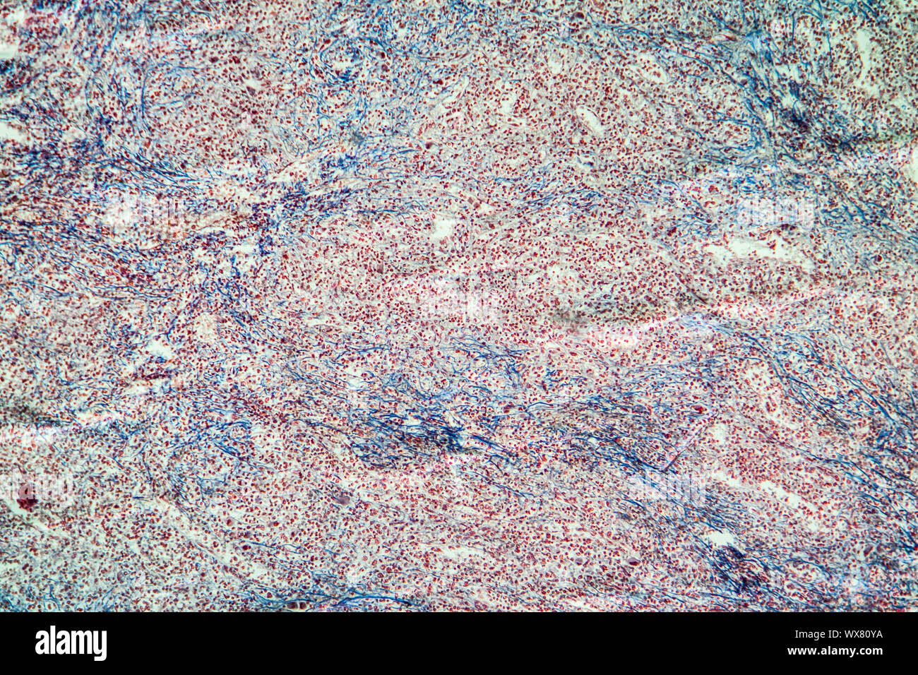 Cronica leucemia mieloide di milza di un tessuto malato 100x Foto Stock