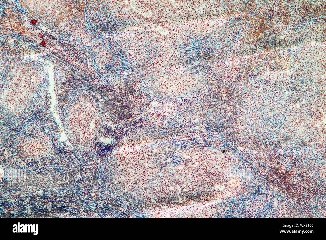 Cronica leucemia mieloide di milza di un tessuto malato 100x Foto Stock