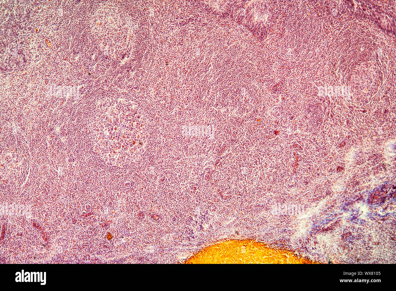 Tonsillite tessuto malato sotto il microscopio 100x Foto Stock