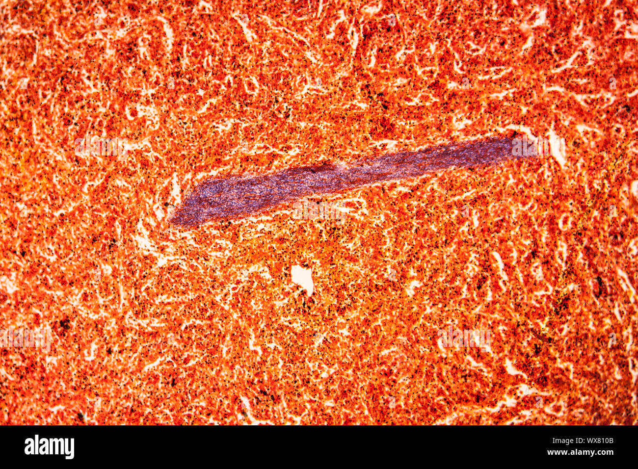 La malaria melanoma della milza di un tessuto malato 100x Foto Stock