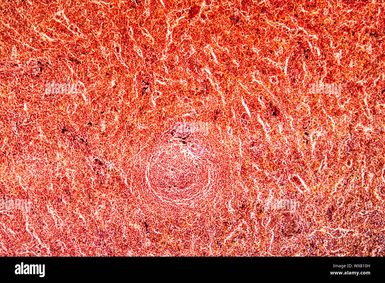 La malaria melanoma della milza di un tessuto malato 100x Foto Stock