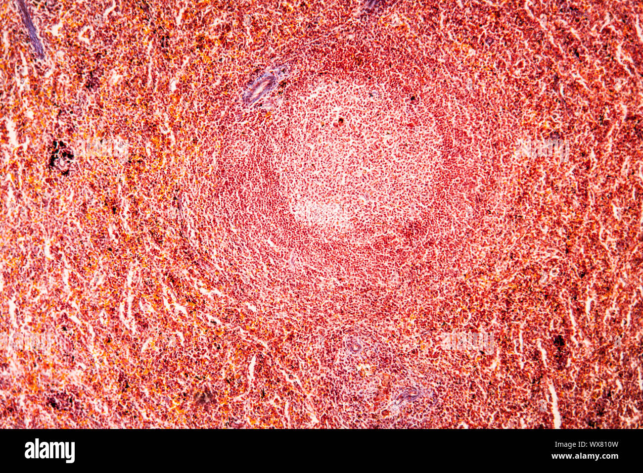 La malaria melanoma della milza di un tessuto malato 100x Foto Stock