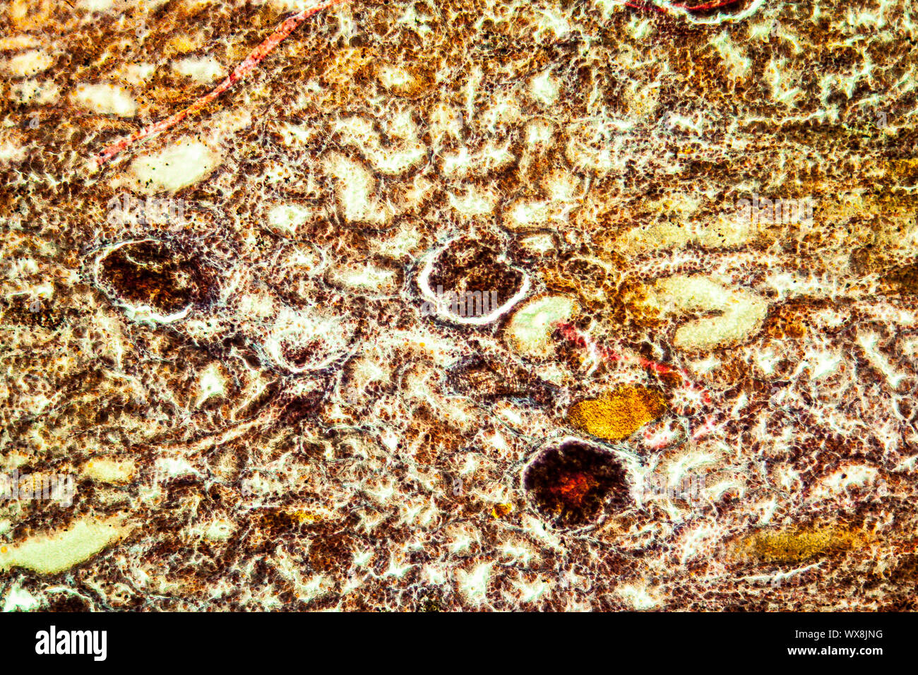 Emorragie renali di un tessuto malato 100x Foto Stock