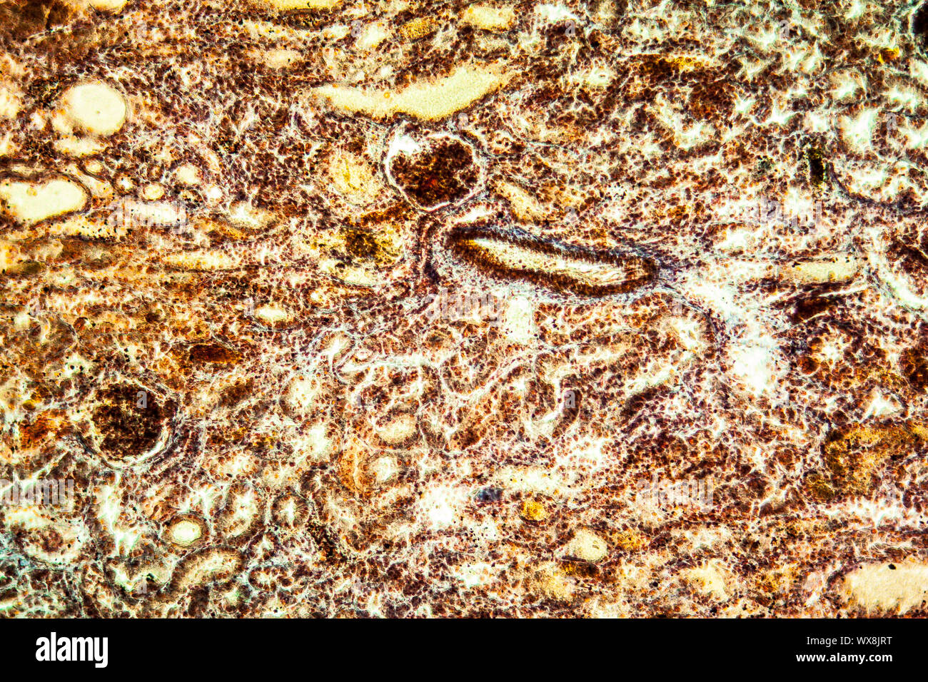 Emorragie renali di un tessuto malato 100x Foto Stock