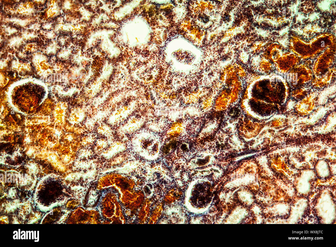 Emorragie renali di un tessuto malato 100x Foto Stock