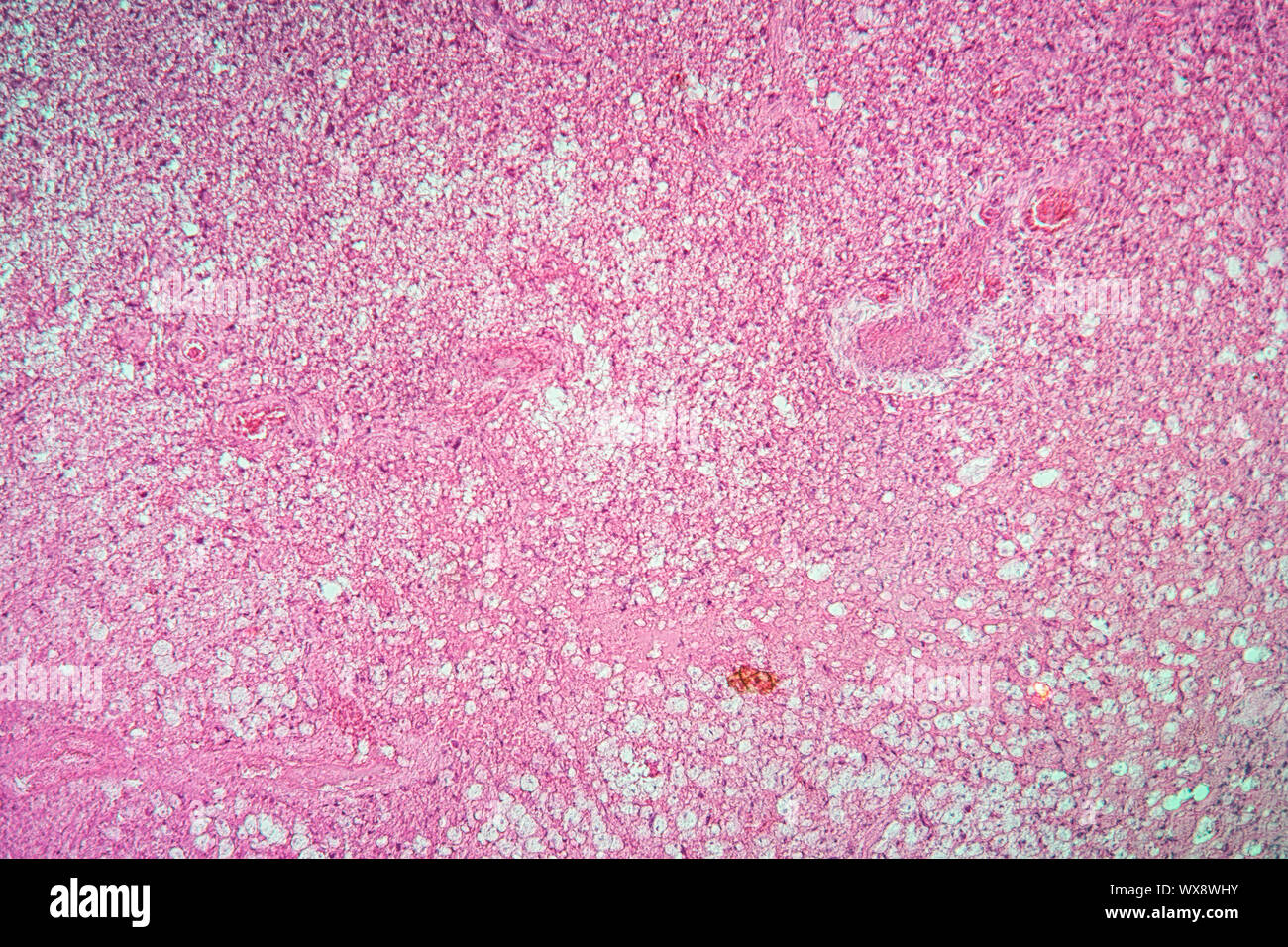 Glioma tumore del cervello di un tessuto malato 100x Foto Stock
