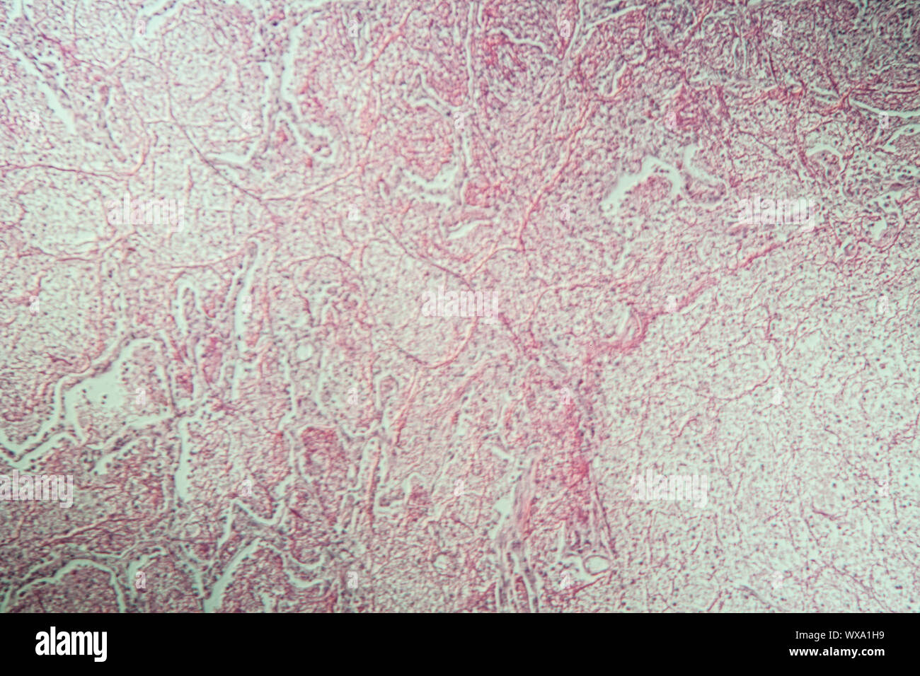 La polmonite tessuto infiammato sotto il microscopio 100x Foto Stock