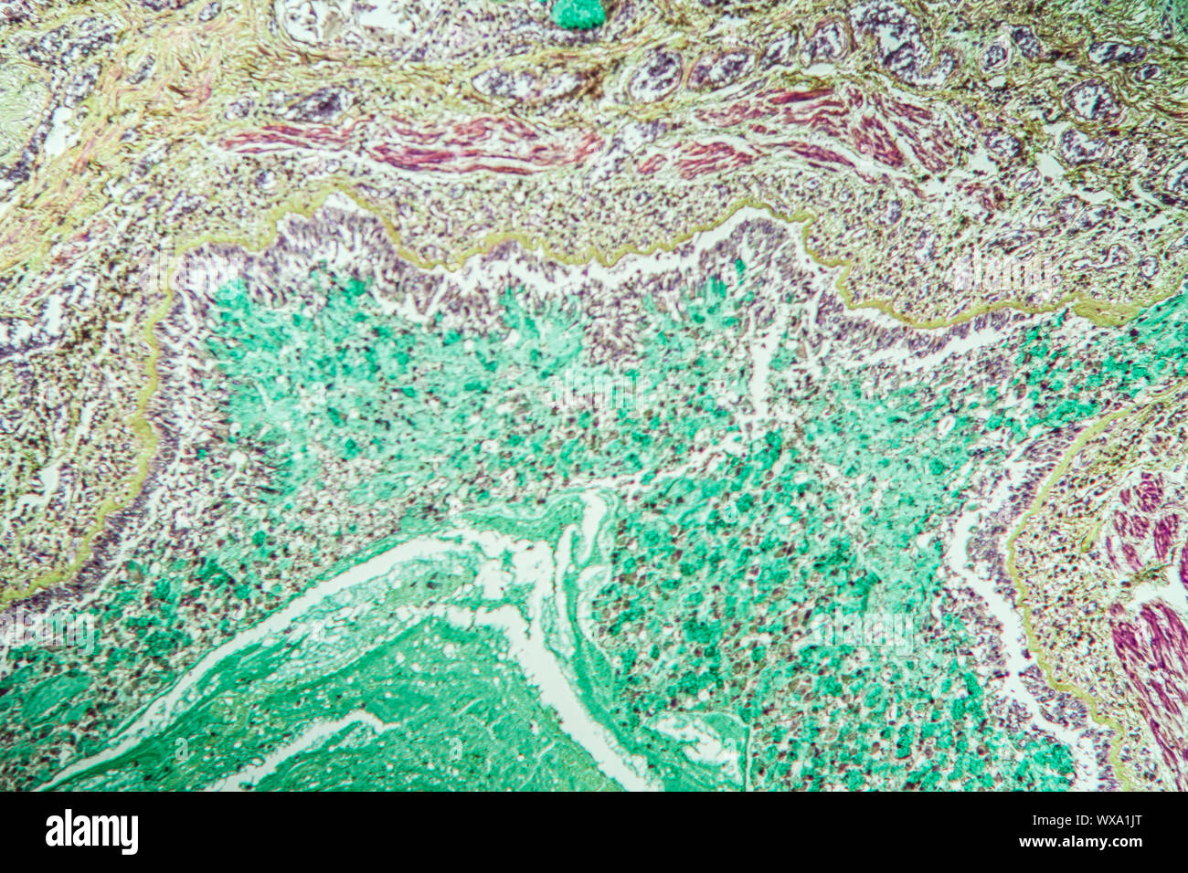 Asma tessuto polmonare sotto il microscopio 100x Foto Stock