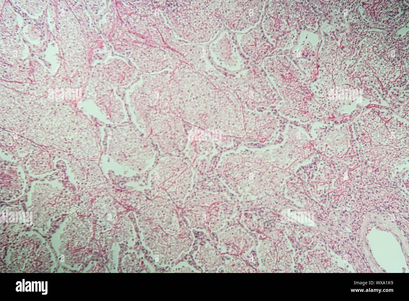 La polmonite tessuto infiammato sotto il microscopio 100x Foto Stock