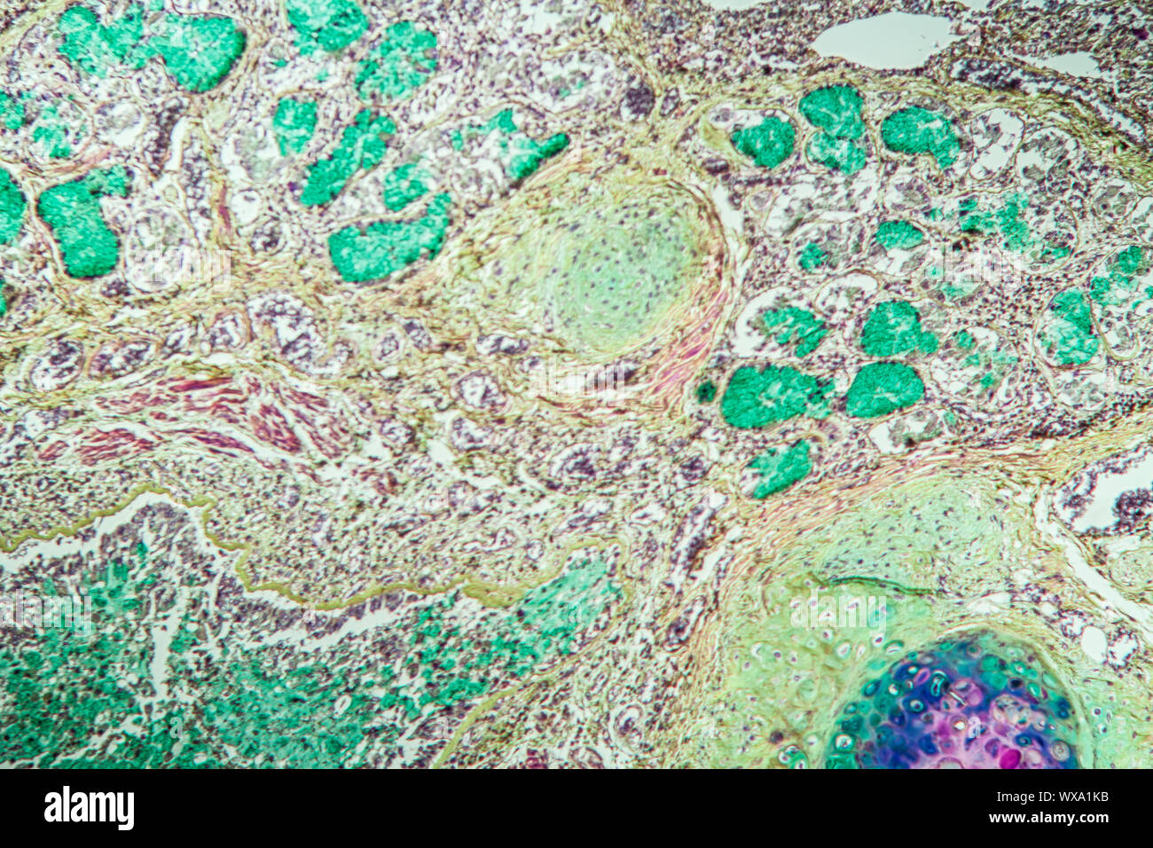 Asma tessuto polmonare sotto il microscopio 100x Foto Stock