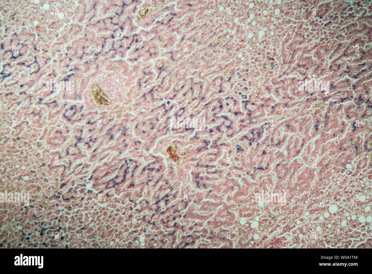 Emosiderosi fegato sotto il microscopio 100x Foto Stock
