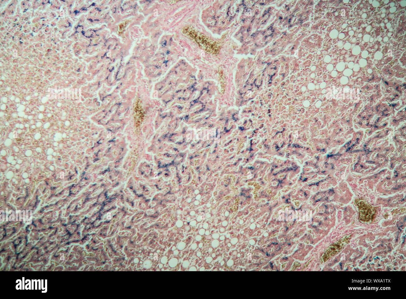 Emosiderosi fegato sotto il microscopio 100x Foto Stock