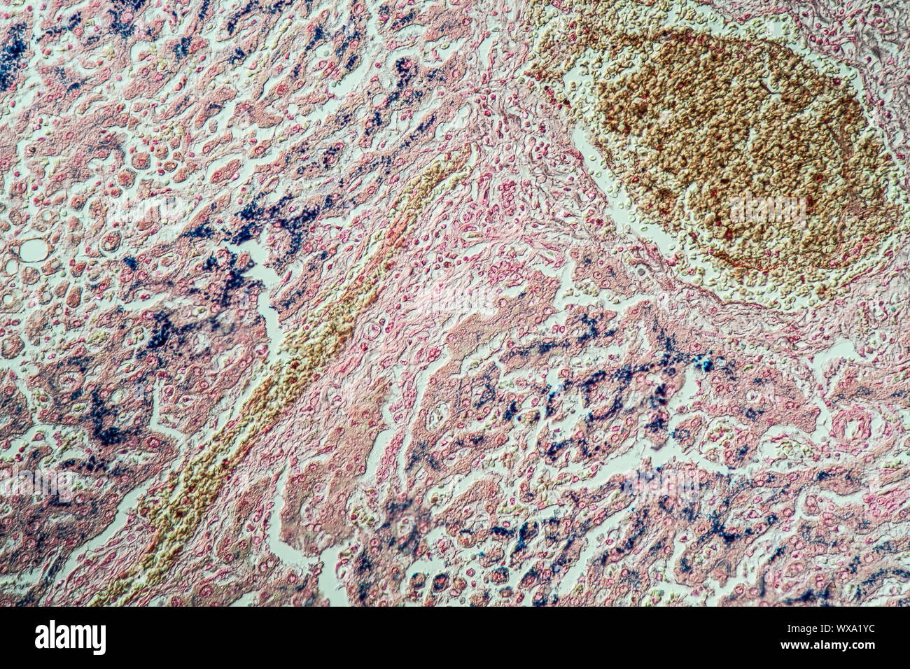 Emosiderosi fegato sotto il microscopio 100x Foto Stock