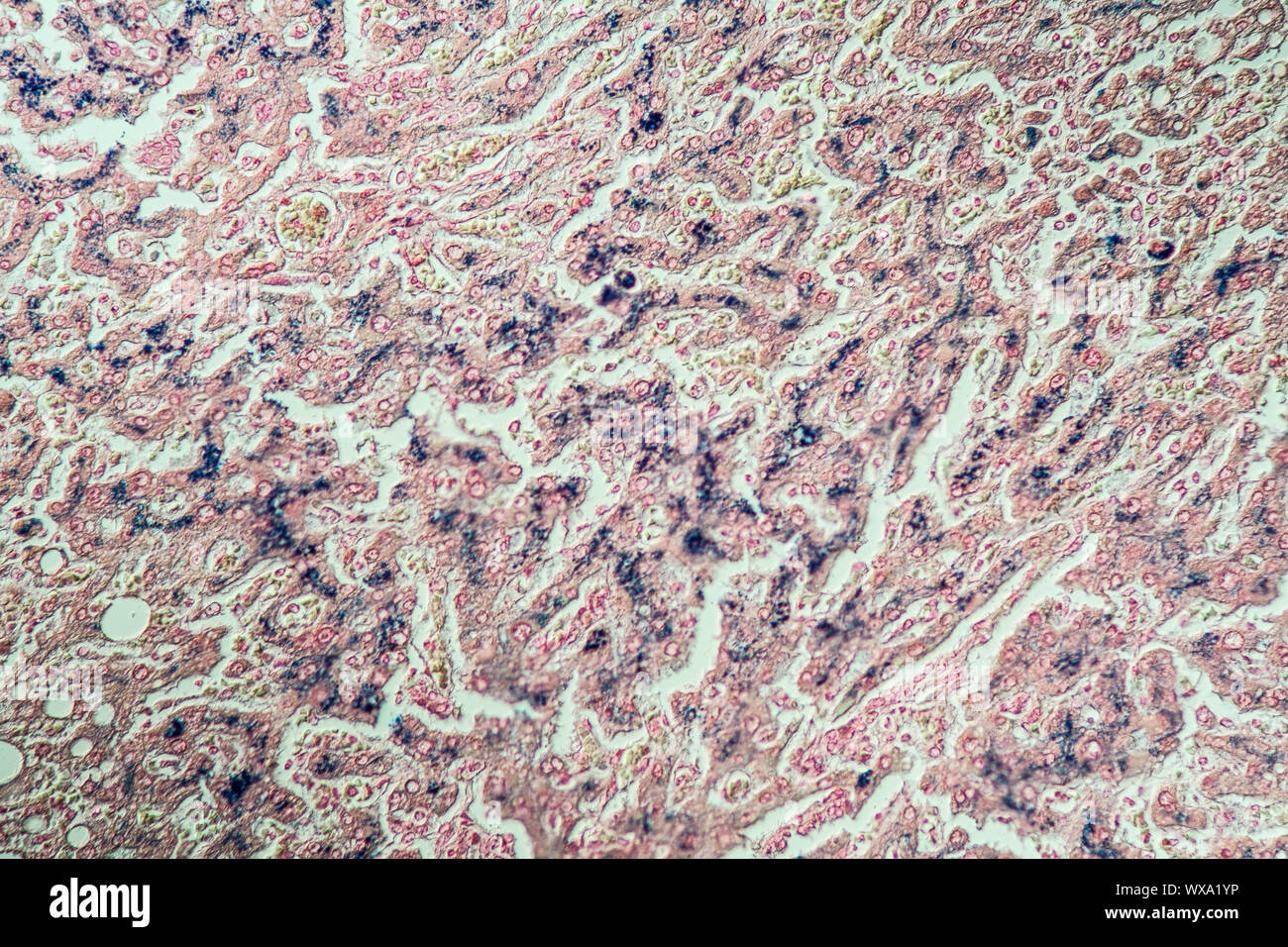 Emosiderosi fegato sotto il microscopio 100x Foto Stock