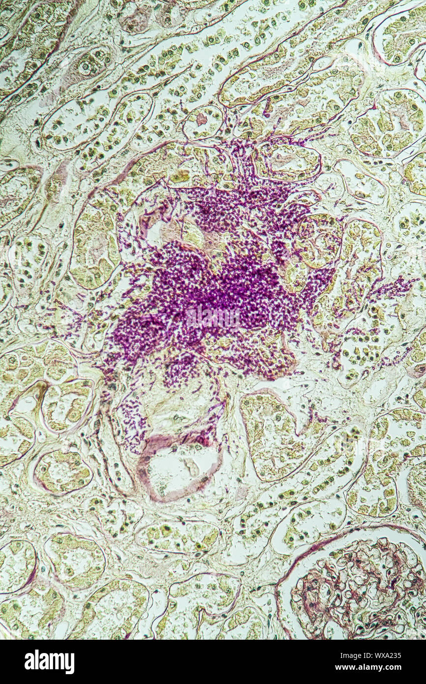 Un rene di pazienti affetti da AIDS del tessuto con il fungo Candida crescere attraverso 200x Foto Stock
