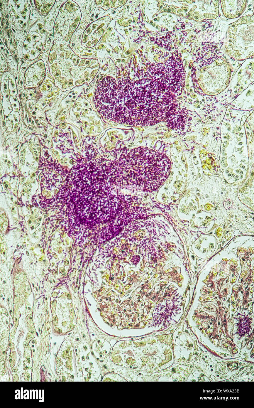Un rene di pazienti affetti da AIDS del tessuto con il fungo Candida crescere attraverso 200x Foto Stock
