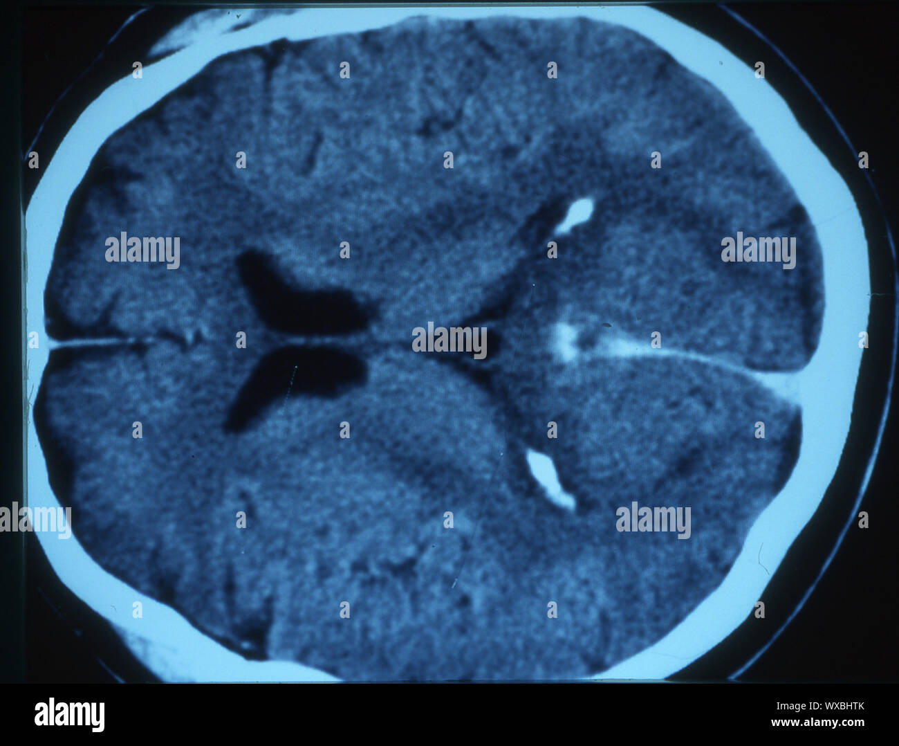 Tomografia computerizzata della testa umana Foto Stock