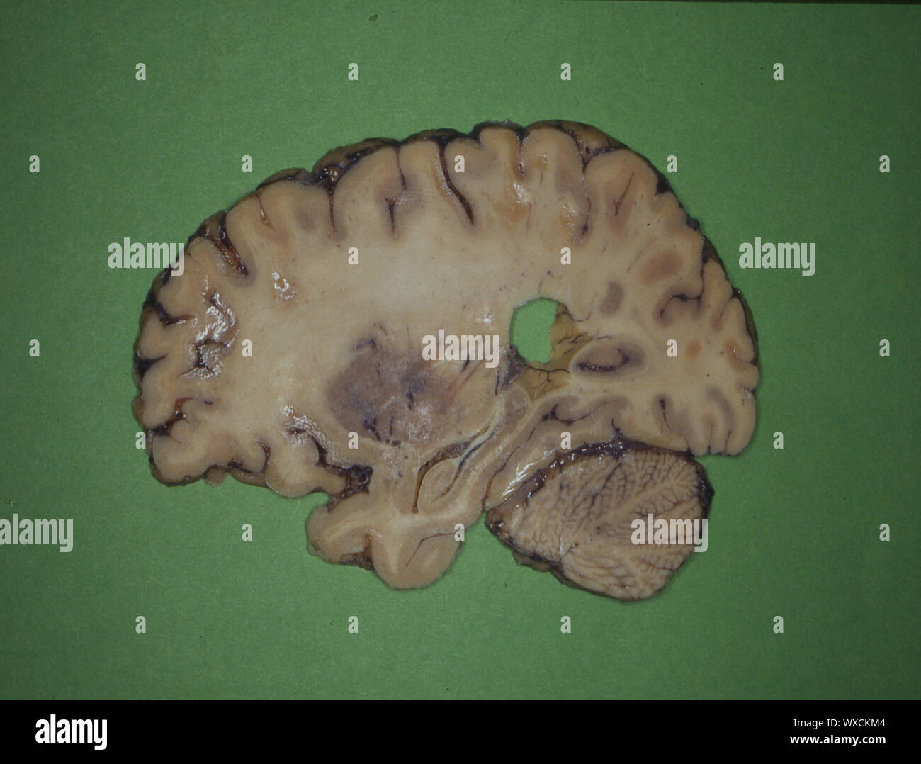 Cervello umano in sezione longitudinale ed in sezione trasversale Foto Stock