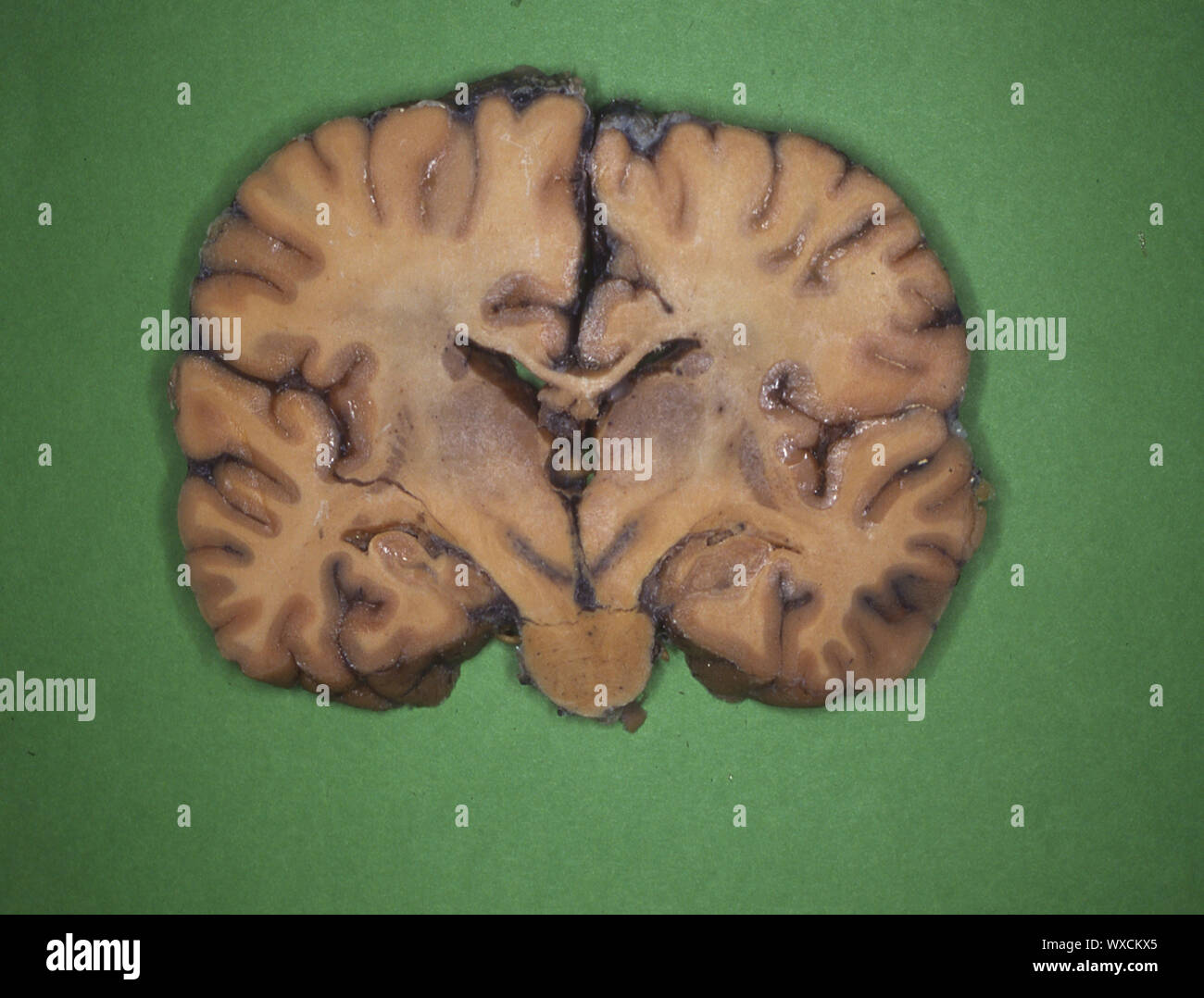Cervello umano in sezione longitudinale ed in sezione trasversale Foto Stock