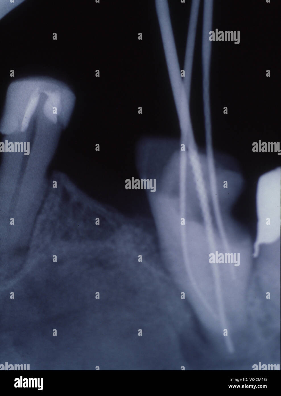 X-ray dei denti con otturazioni e ponti Foto Stock