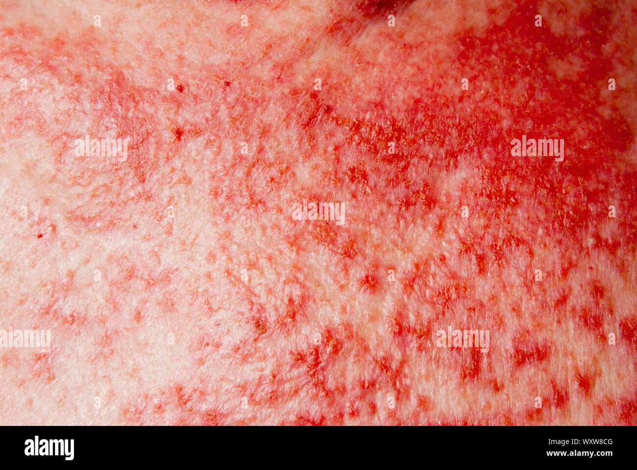 Il carcinoma a cellule basali del cancro della pelle trattata con 5 percento fluorouracile unguento topici medicina. Foto Stock