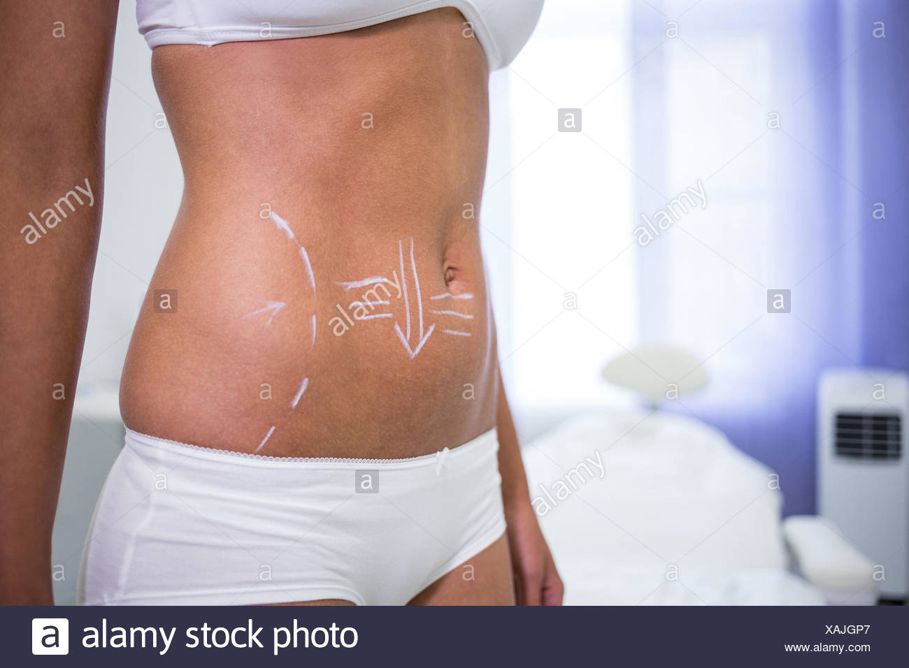 cellulite addome